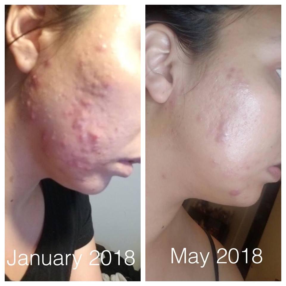 Super Acne Fighter Essential Oils treatment