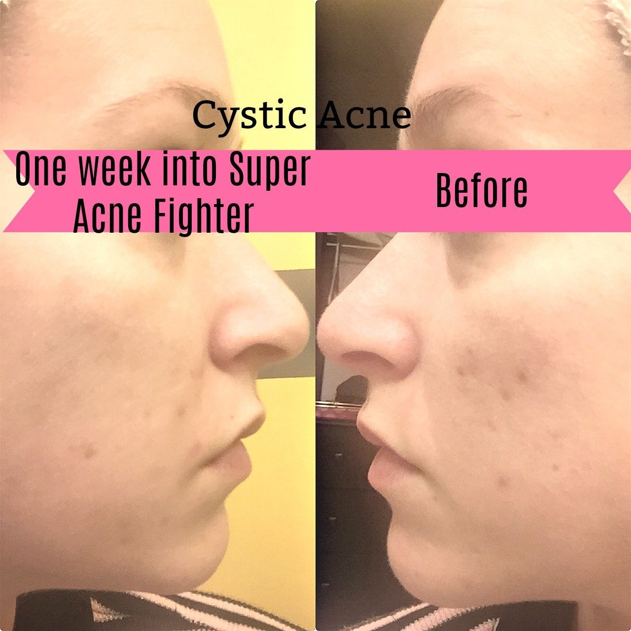 Super Acne Fighter Essential Oils treatment