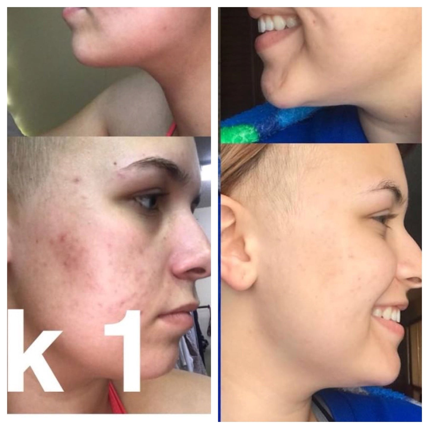 Super Acne Fighter Essential Oils treatment